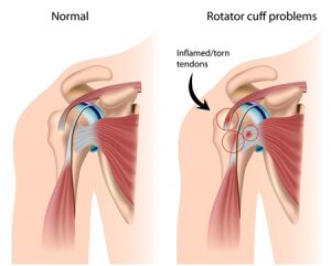 shoulder impingement, rotator cuff