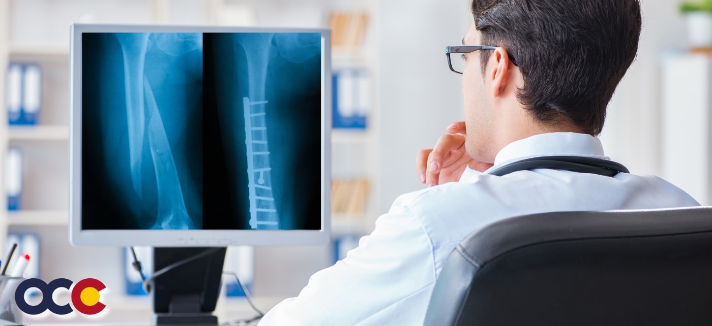 Fractured Femur